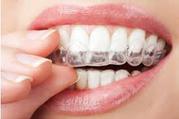 Othodontic aligners - The Invisible Option